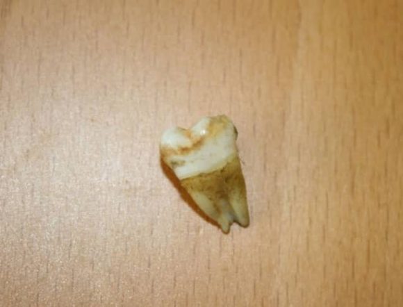 John Lennon's tooth, sold at auction in 2011