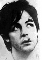 Paul McCartney after his moped accident, December 1965