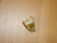 John Lennon's tooth, sold at auction in 2011