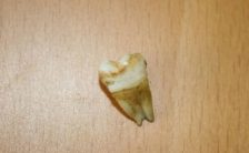 John Lennon's tooth, sold at auction in 2011