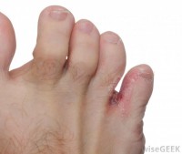 toe-jam-accumulated-between-little-toe.jpg